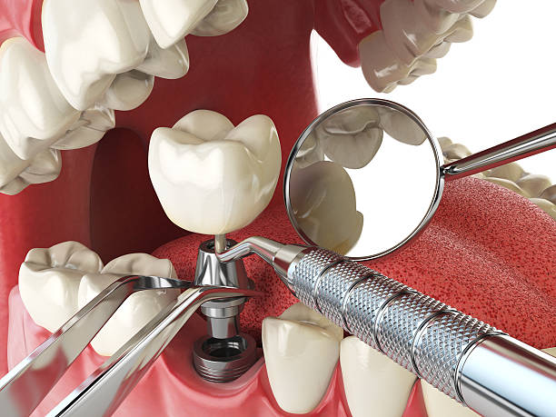 Best Emergency Wisdom Teeth Removal in Campbellsburg, KY